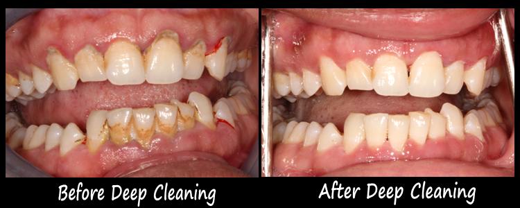 Before and After Photos of Dental Work by Marrero Dentists